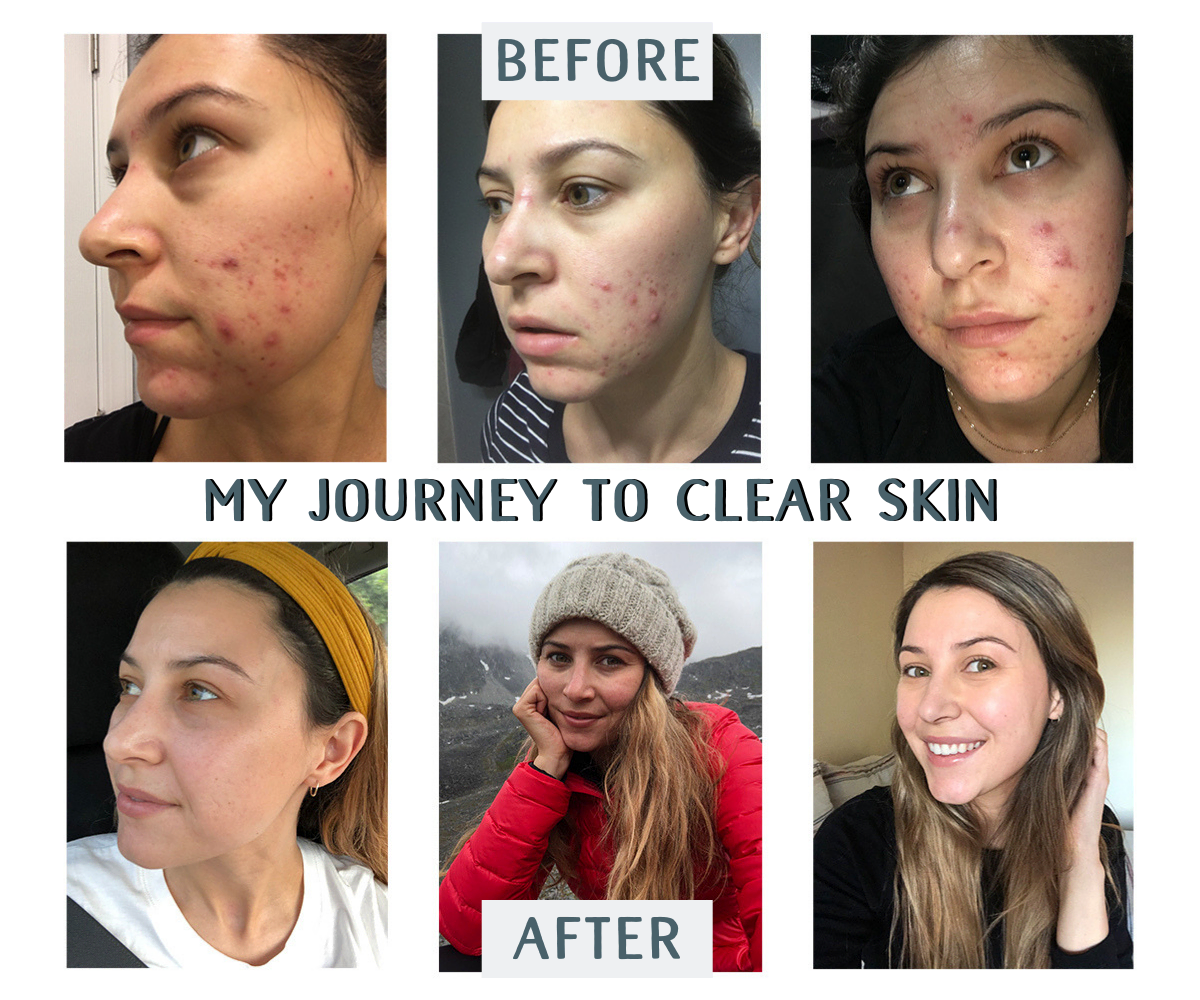 My Journey To Clear Skin